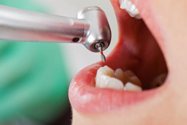 Best Emergency Dental Care for Broken or Chipped Teeth in Hawaiian Beaches, HI